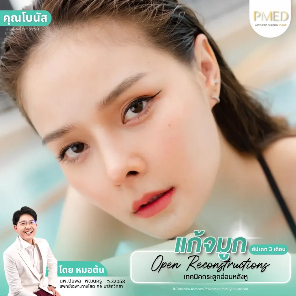 การเสริมจมูกด้วยกระดูกอ่อนหลังหูคืออะไร? เทคนิคยอดนิยม ลดความเสี่ยงจมูกทะลุ