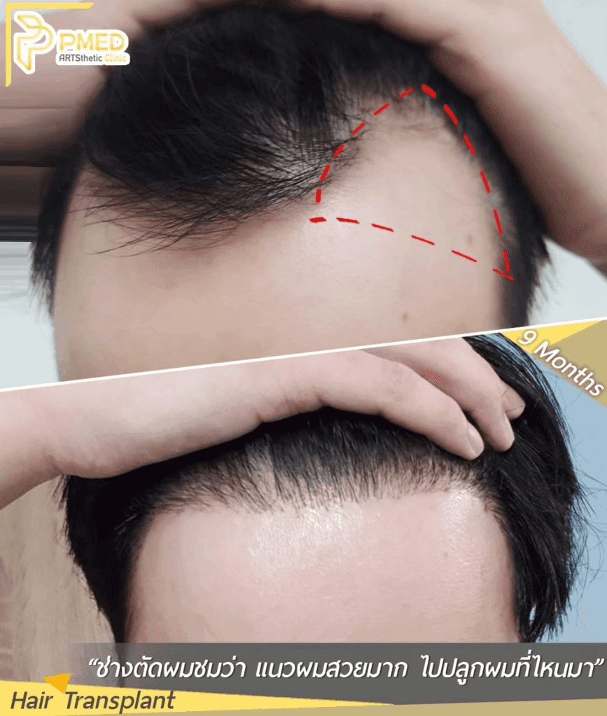 การปลูกผมคืออะไร? คู่มือฉบับเต็มสำหรับผู้มีปัญหาผมบาง ศีรษะล้าน