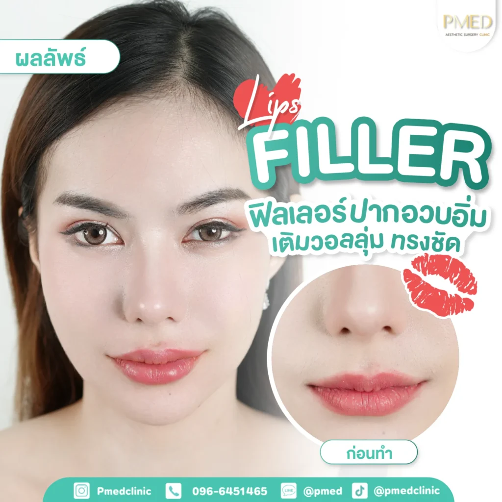 สัญญาณฟิลเลอร์เป็นก้อน แบบไหนปกติ? แบบไหนอันตราย?