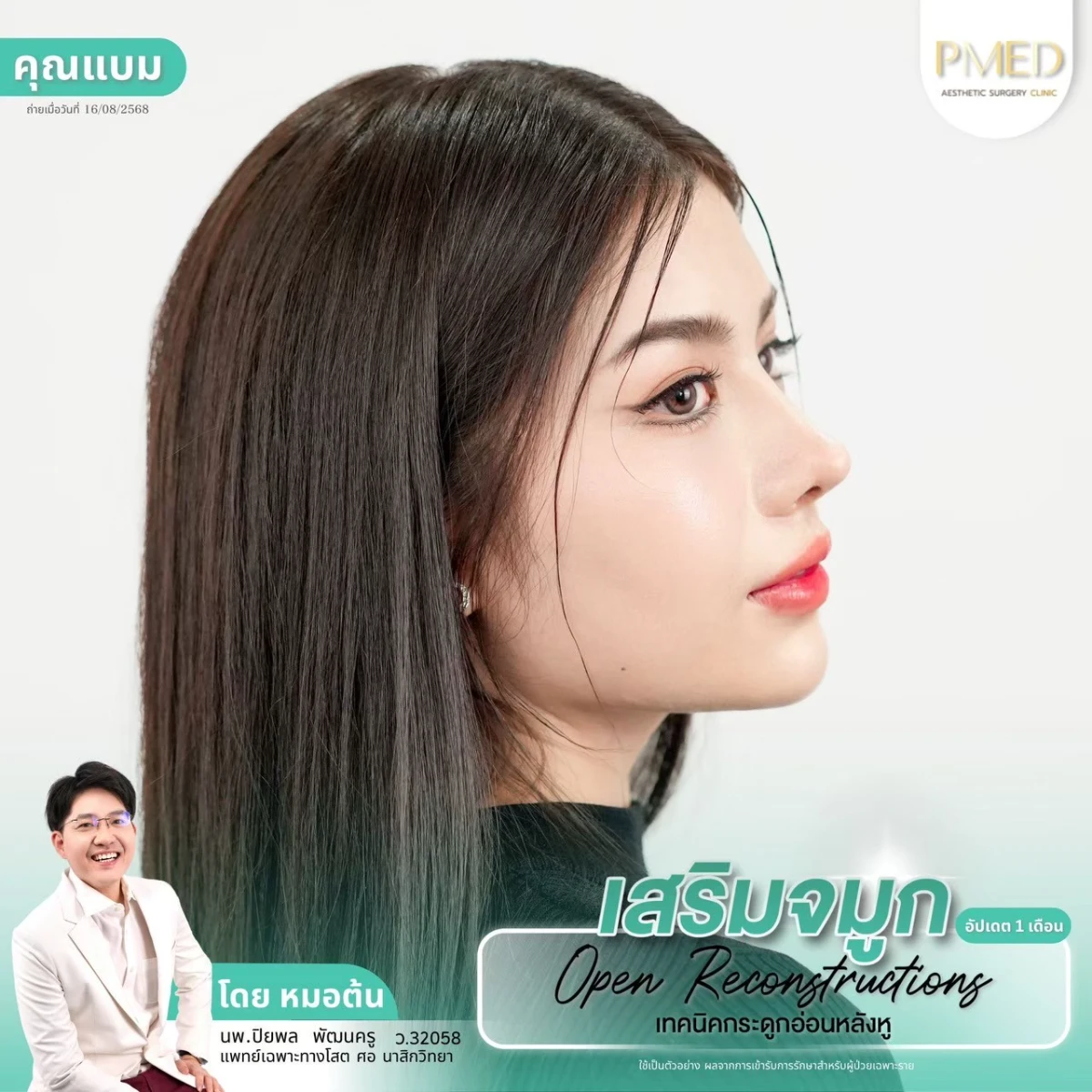 LINE_ALBUM_จมูก 👂🏻 เทคนิคกระดูกอ่อนหลังหู_260715_45