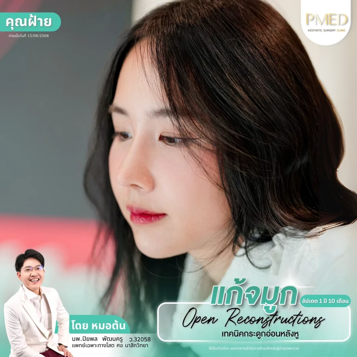 LINE_ALBUM_จมูก 👂🏻 เทคนิคกระดูกอ่อนหลังหู_260715_53