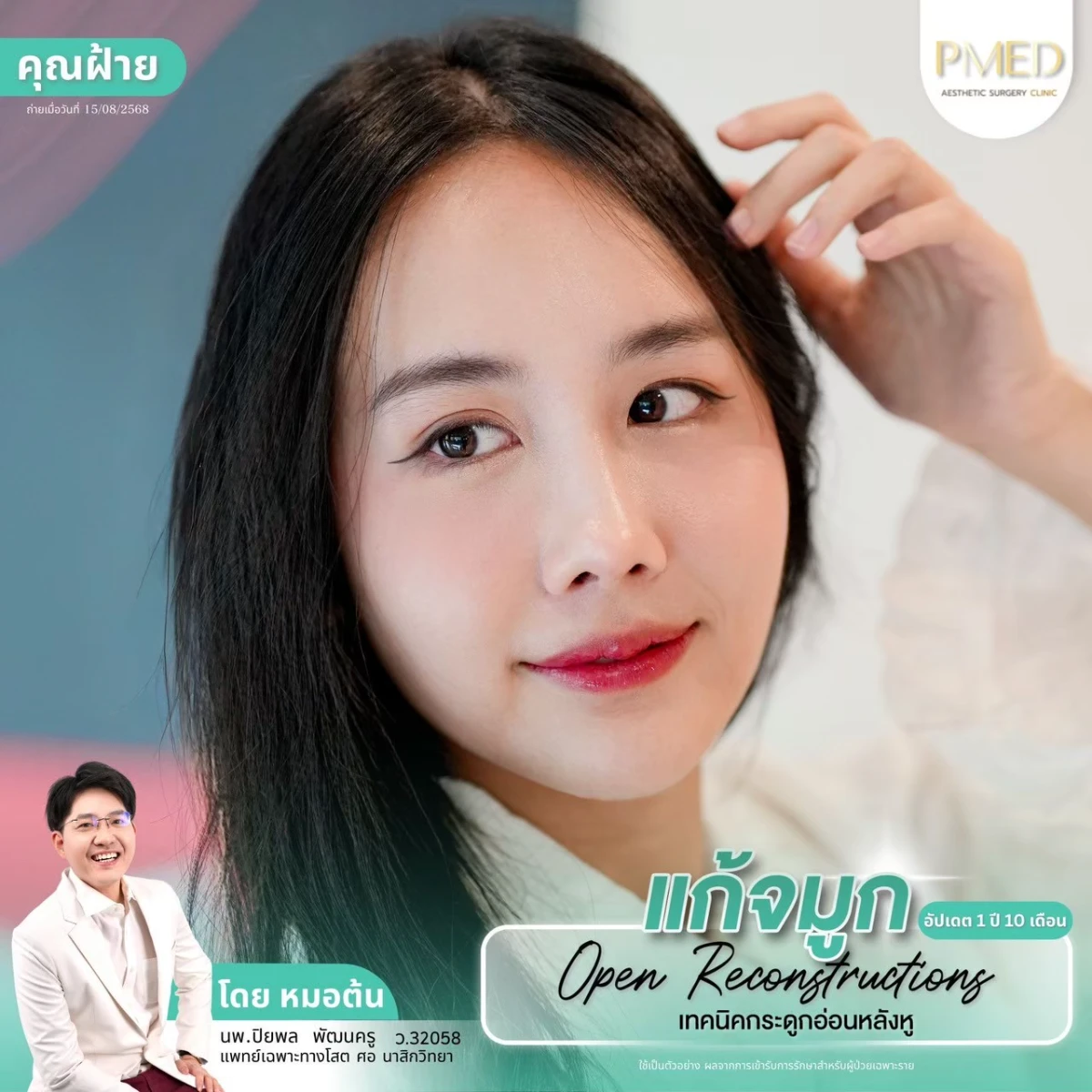 LINE_ALBUM_จมูก 👂🏻 เทคนิคกระดูกอ่อนหลังหู_260715_54