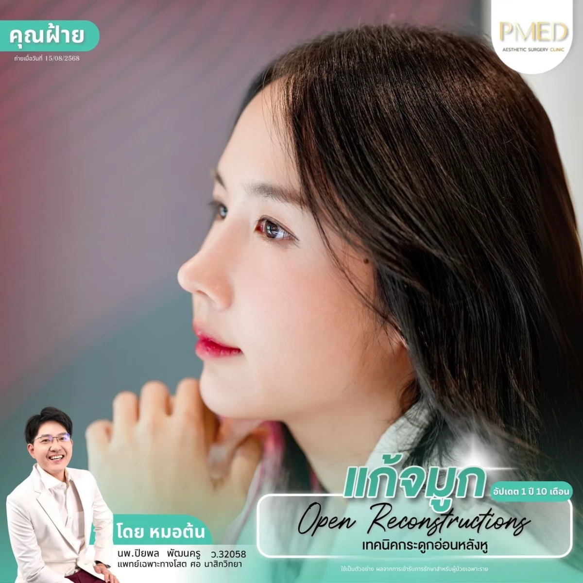 LINE_ALBUM_จมูก 👂🏻 เทคนิคกระดูกอ่อนหลังหู_260715_55