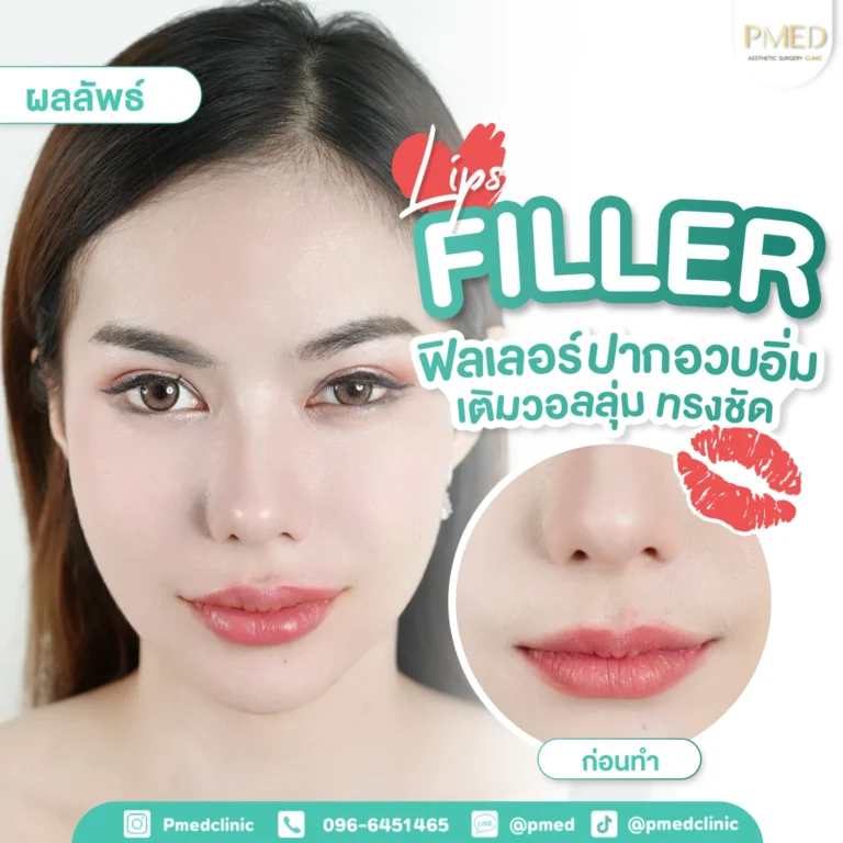 รีวิวฉีดฟิลเลอร์พีเมด4-768x768